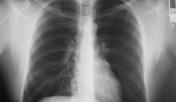 Бронхит на рентгеновском снимке: как распознать болезнь