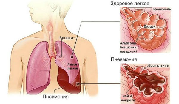 Проявления бактериальной пневмонии