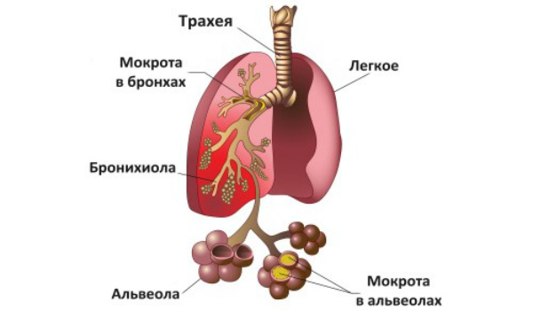 Симптоматика, виды, диагностика и лечение различных видов пневмоний