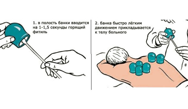 Сколько надо банок. Как правильно ставить банки на спину при кашле. Как правильно поставить медицинские банки на спину при кашле. Как правильно поставить медицинские банки при кашле. Как ставить банки на спину схема.